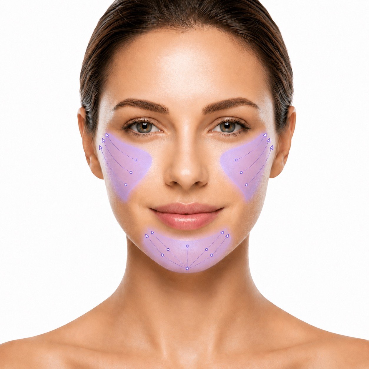 Lamaro Lift — Cheek Filler Image 2