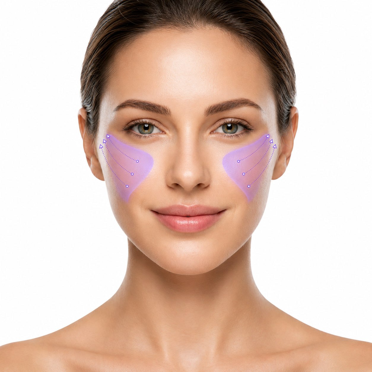 Lamaro Lift — Cheek Filler Image 3